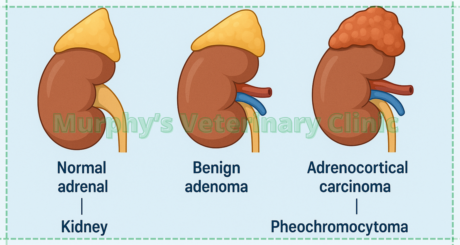 1 Common Types of Adrenal Gland Tumors